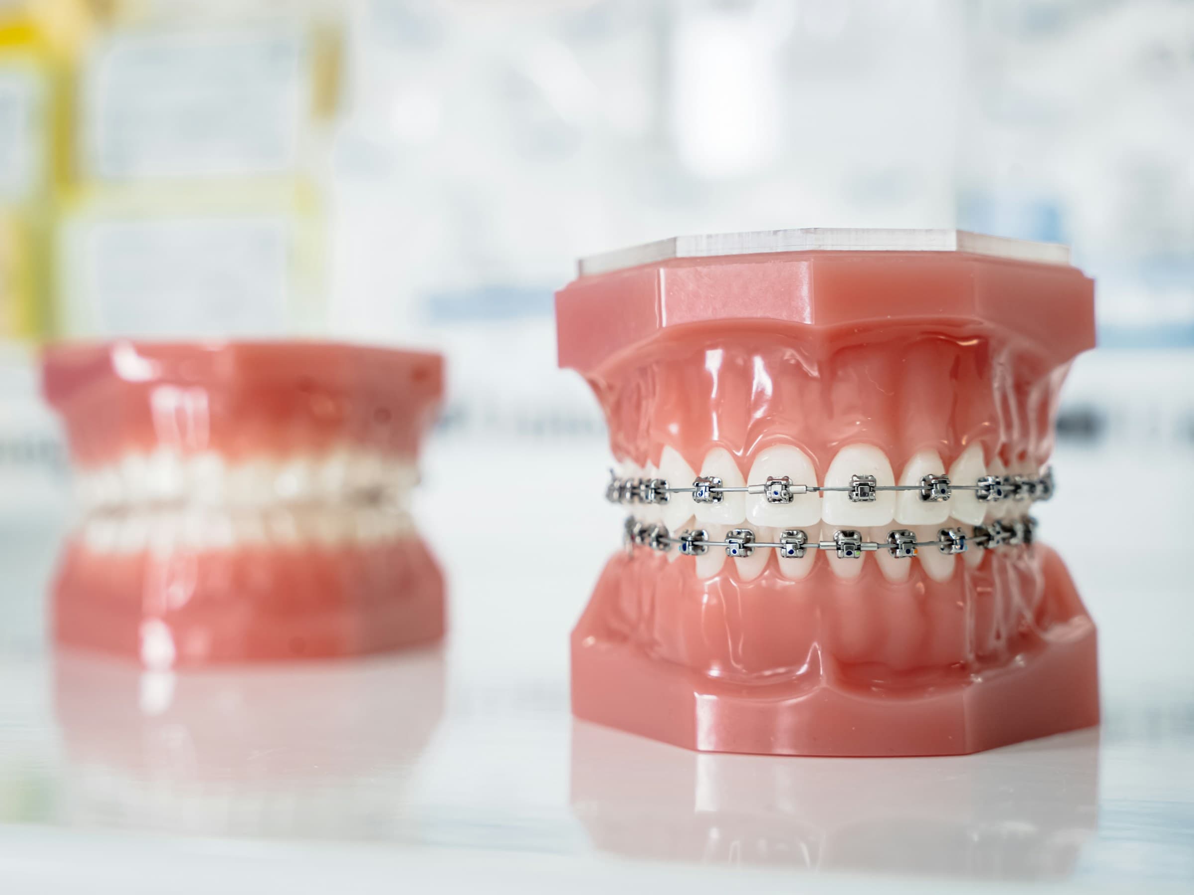 Modelos odontológicos com aparelho fixo em close, em preto e branco